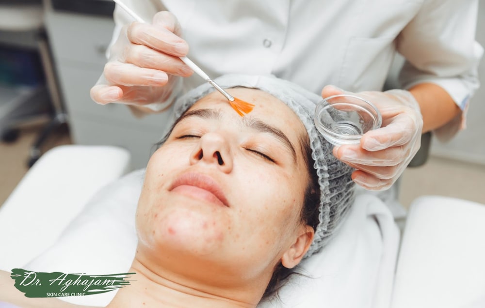 لایهبرداری شیمیایی یا پیلینگ شیمیایی