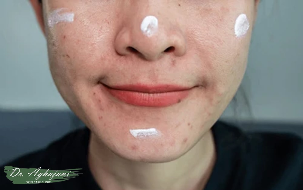 کرم یا پماد برای از بین بردن جای جوش صورت