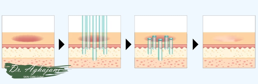 لیزر فرکشنال CO2 یا اربیوم