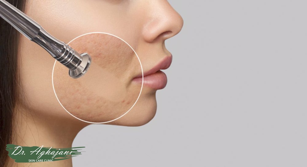 میکرودرم ابریژن