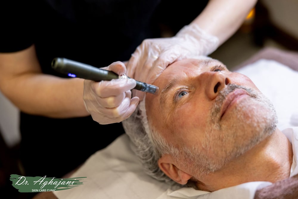 میکرونیدلینگ