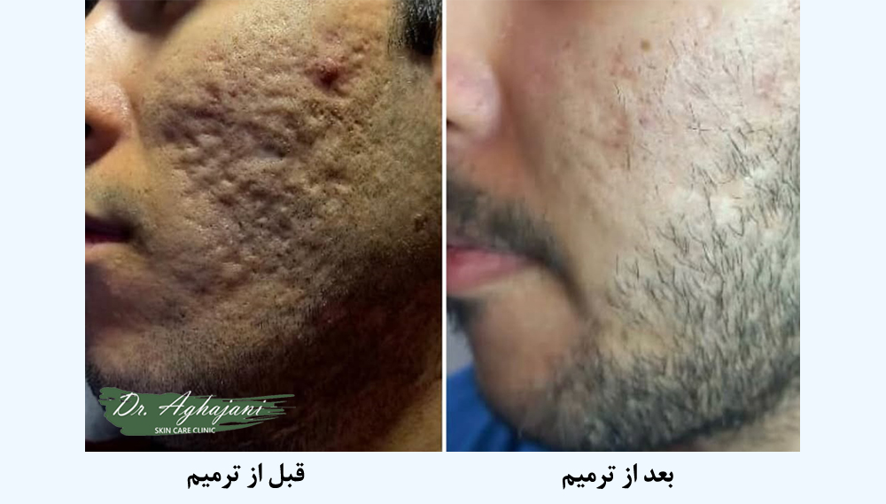 جای آبلهمرغان فرورفته (اسکار آتروفیک)