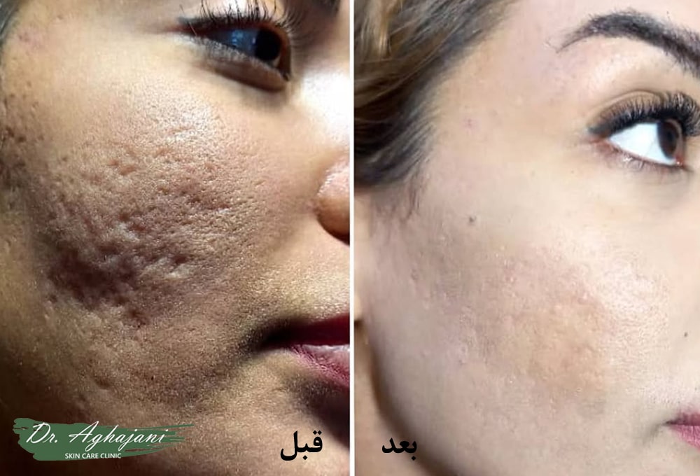 درمان فرورفتگی جای ابله مرغان