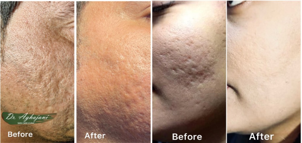 درمان اسکارهای فرورفته