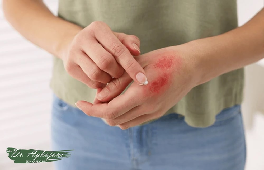 کرم برای جای سوختگی درجه 2 (نسبتاً عمیق – سطح پوست + لایه دوم)