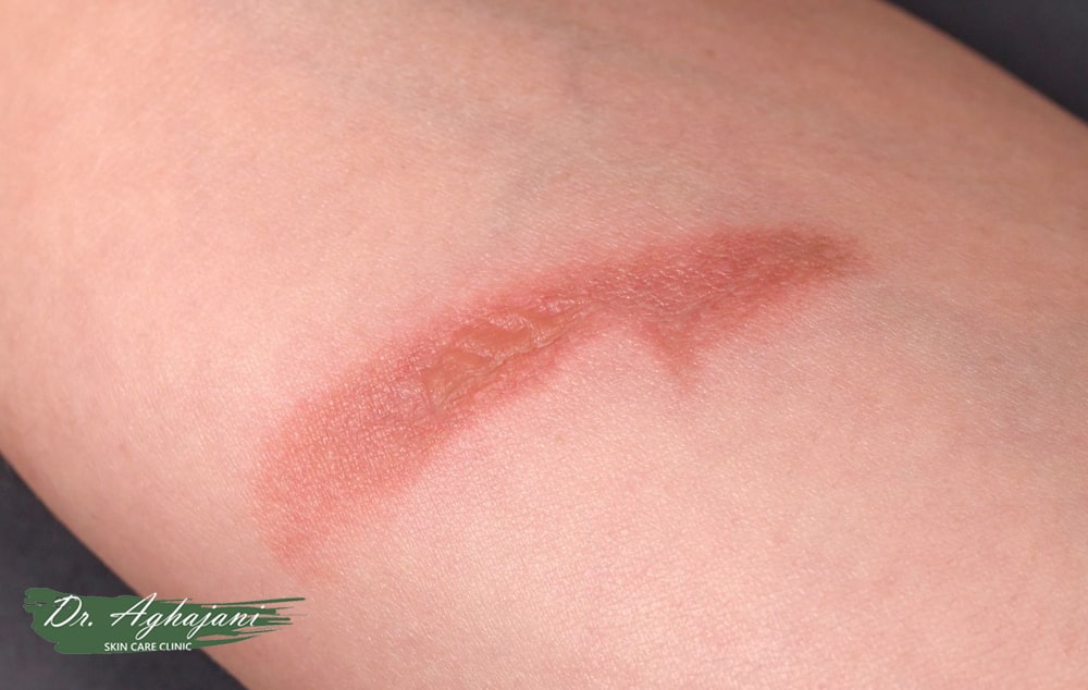 کرم برای جای سوختگی درجه 1 (سطحی – مثل آفتابسوختگی)