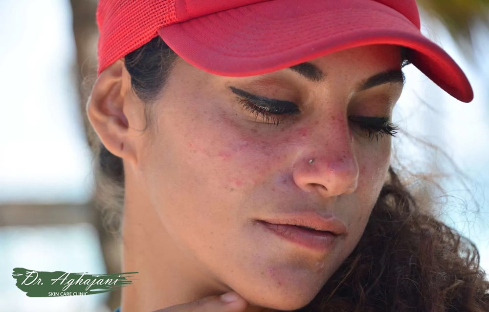 از بین بردن جای سوختگی فوری -تازه