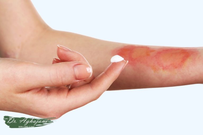 بهترین کرم برای از بین بردن جای سوختگی