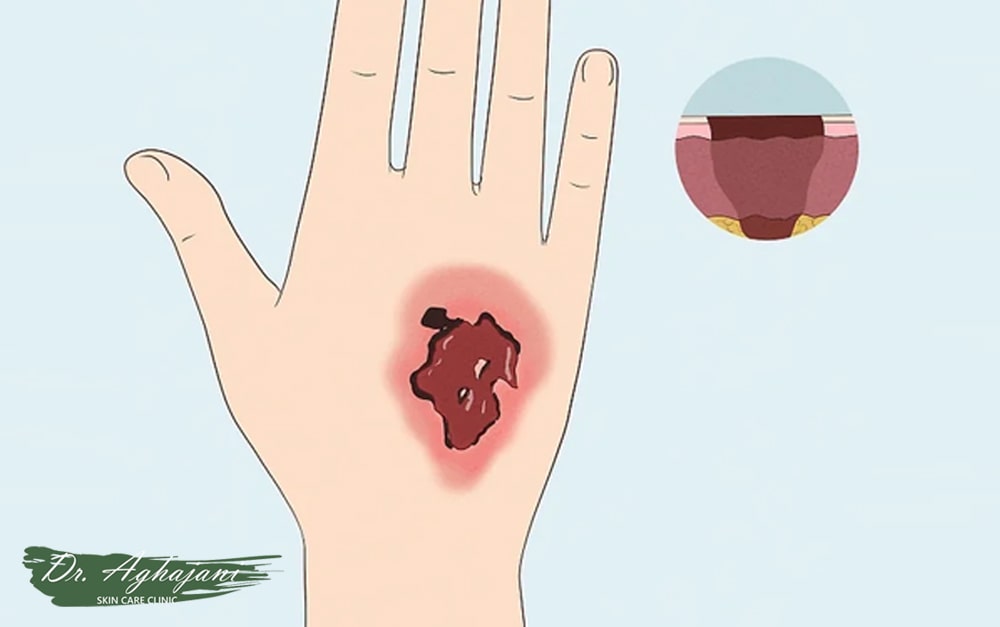 درمان جای سوختگی درجه