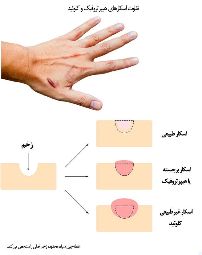  اسکار کلوئیدی (برآمده، وسیع)