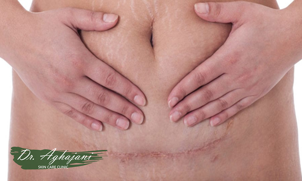 اسکار طبیعی 1