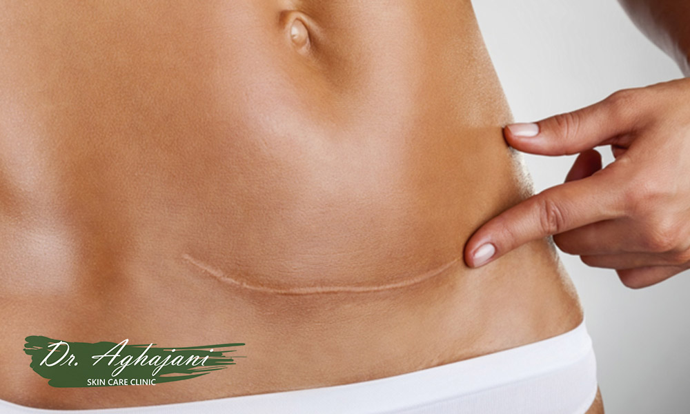 اسکار طبیعی 2