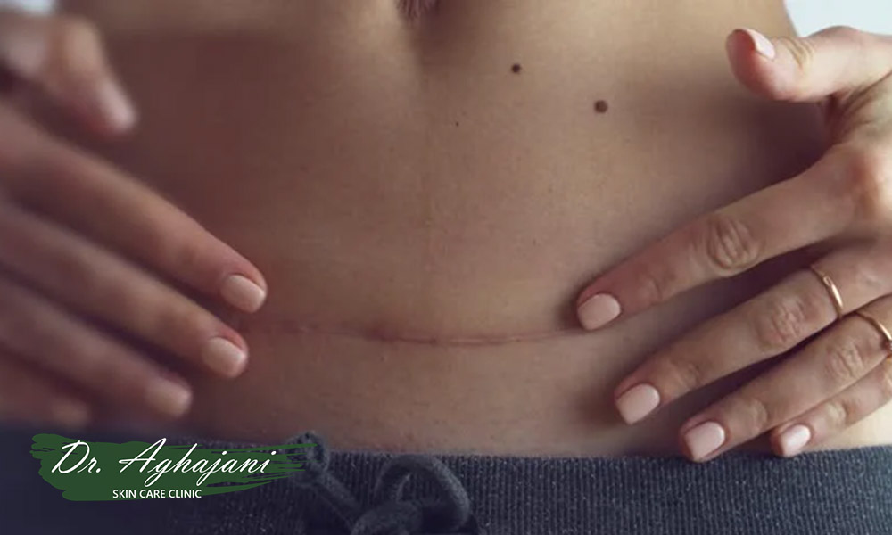 اسکار طبیعی 3