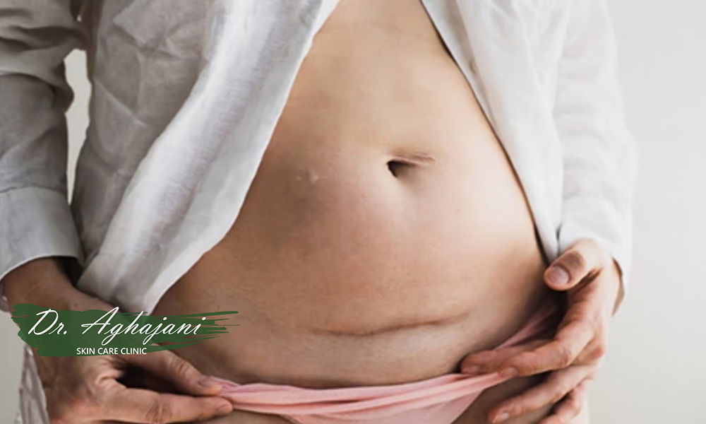 اسکار فرورفته (آتروفیک)