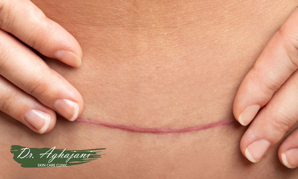 اسکار هیپرتروفیک