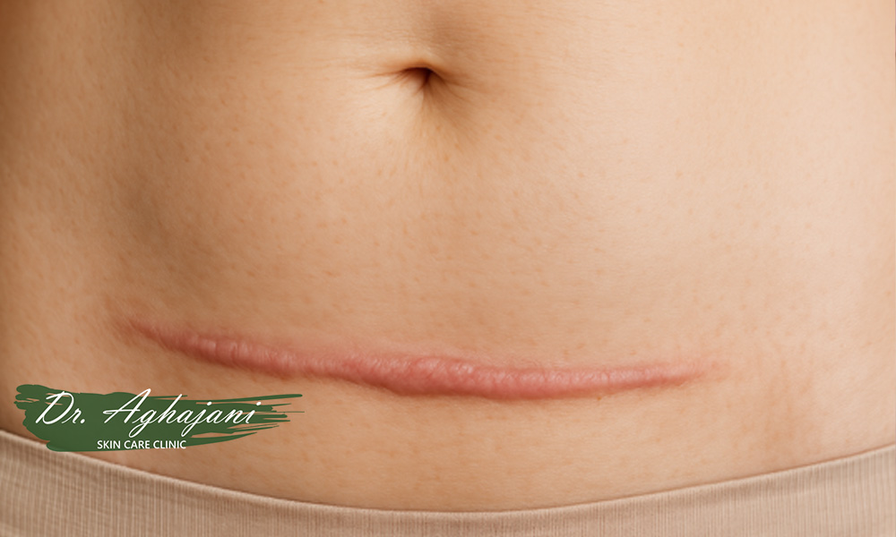 اسکار کلوئید2