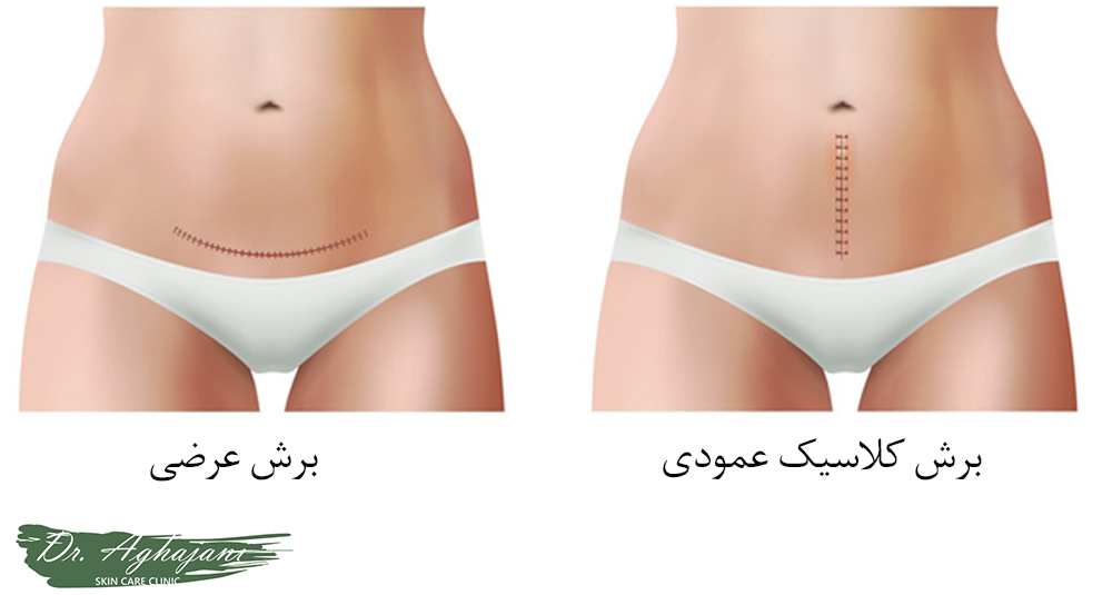 برش های سزارین