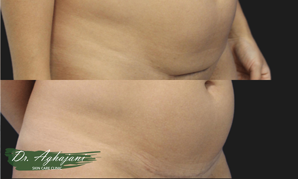 بهترین درمان جای زخم سزارین در کلینیک دکتر آقاجانی