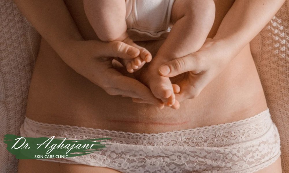 جای زخم سزارین؛ از ظاهر تا درمانهای خانگی و کلینیکی