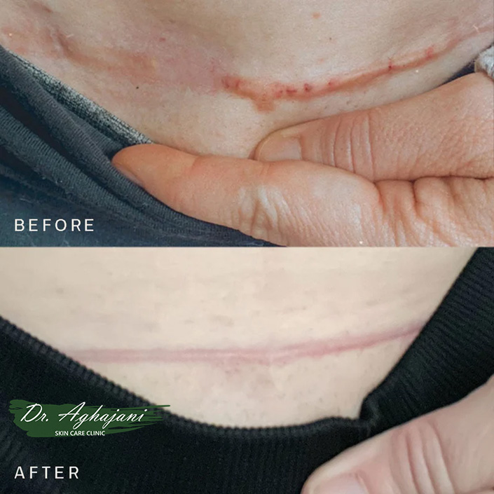 درمان های کلینیکی اسکار کلوئیدی