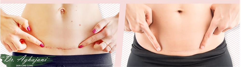 مراقبت اسکار سزارین با تغییر رنگ