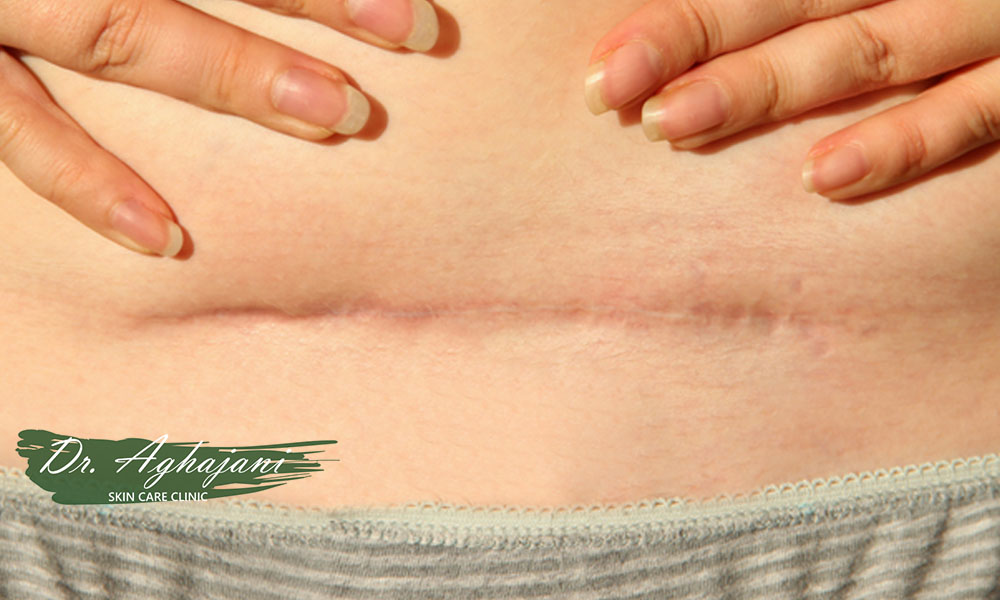 مراقبت های خانگی اسکار فرورفته