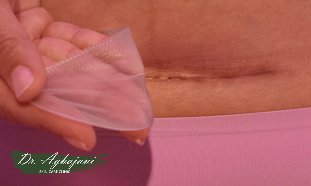 مراقبت های خانگی اسکار هیپرتروفیک