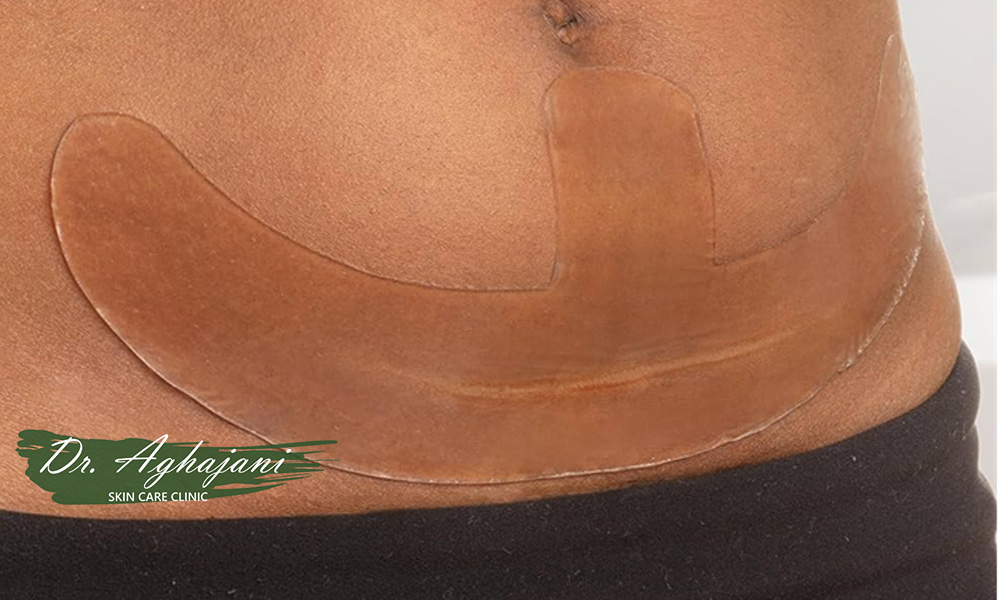 مراقبت های خانگی اسکار کلوئیدی