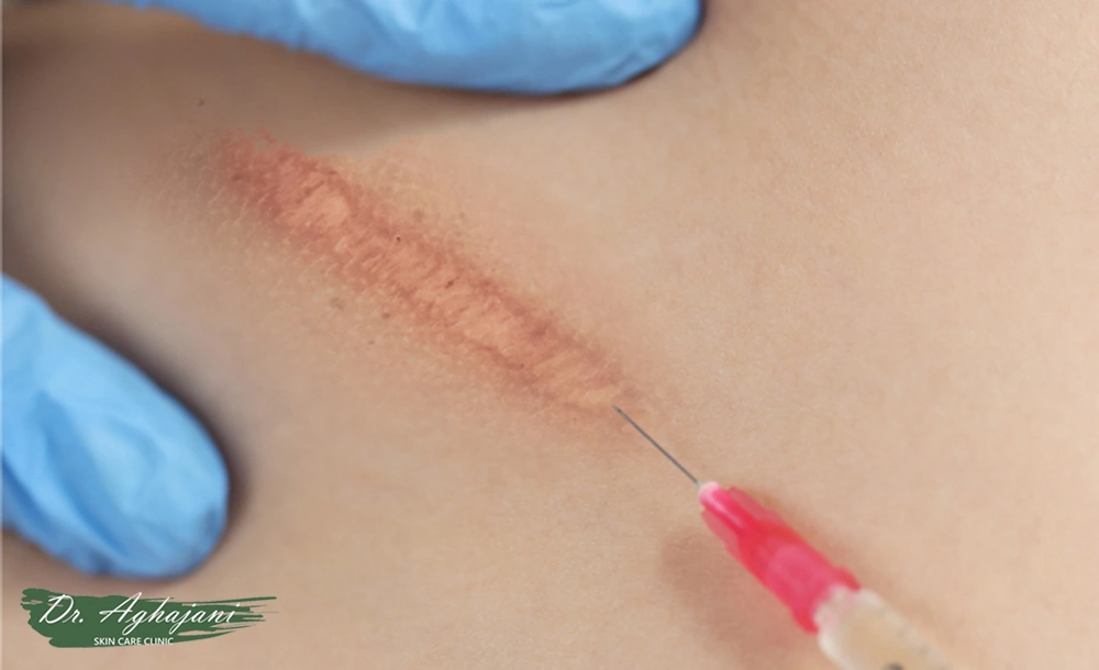 تزریق کورتیکواستروئید