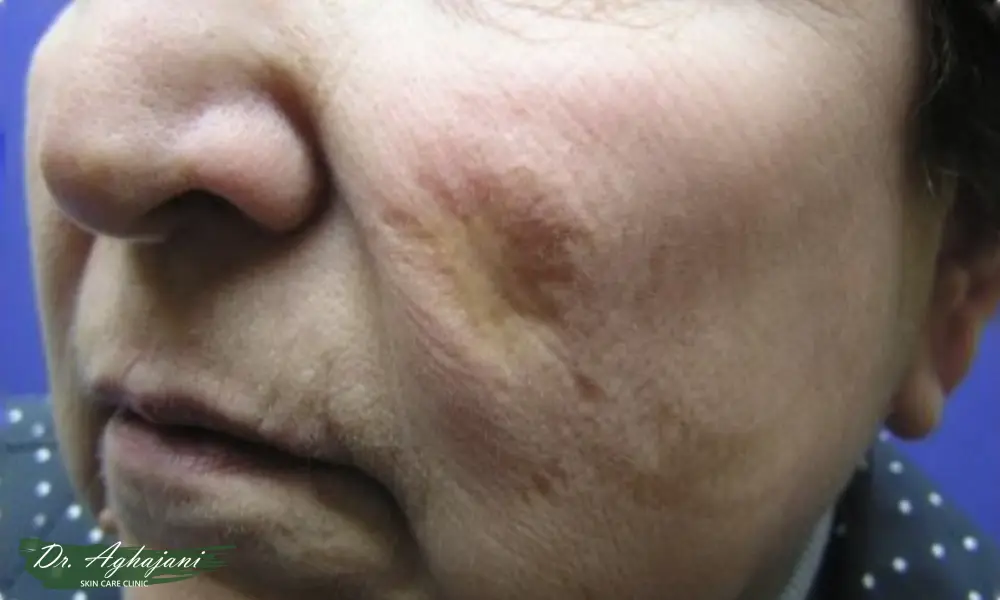 تغییر رنگ اسکار ناشی از سالک