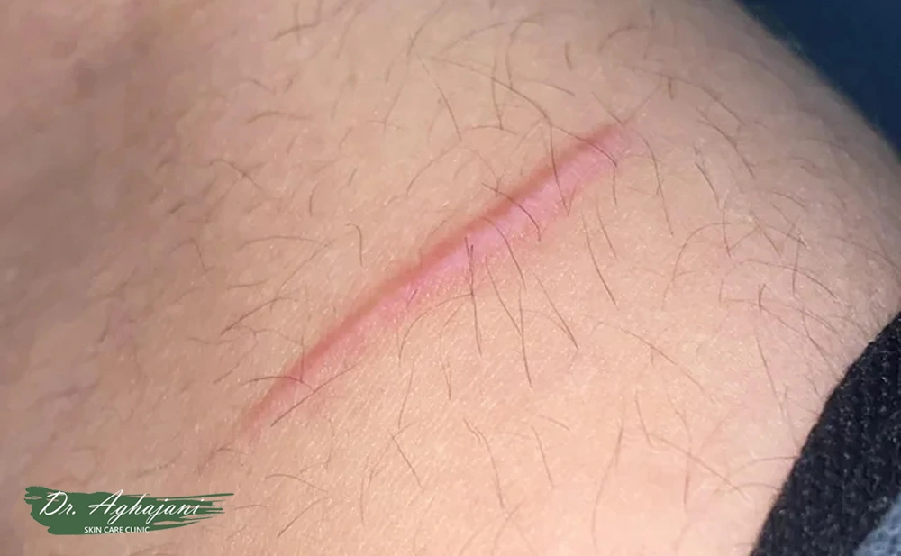 اسکار هیپرتروفیک خطی