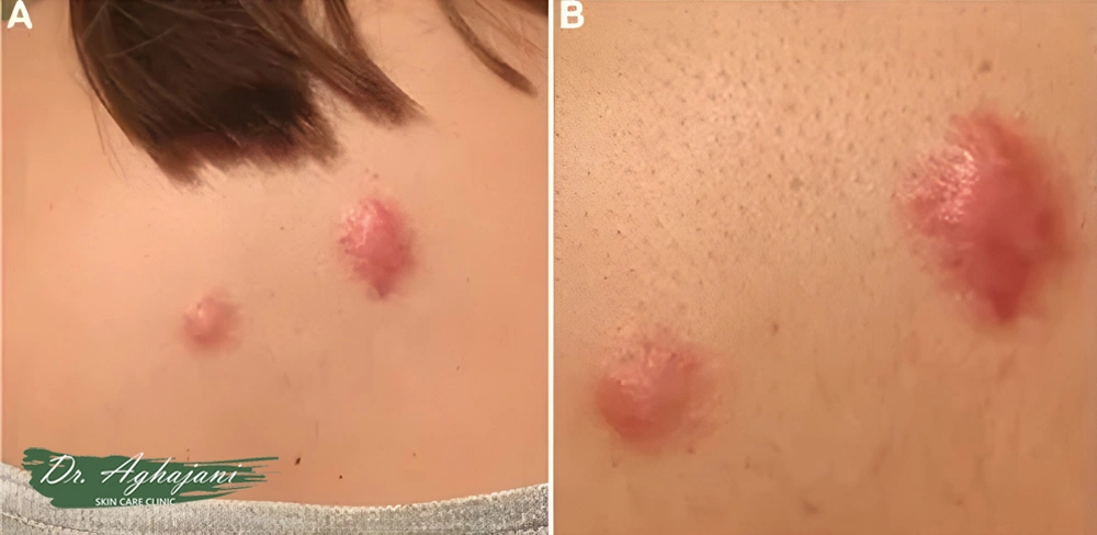 اسکار هیپرتروفیک نقطهای