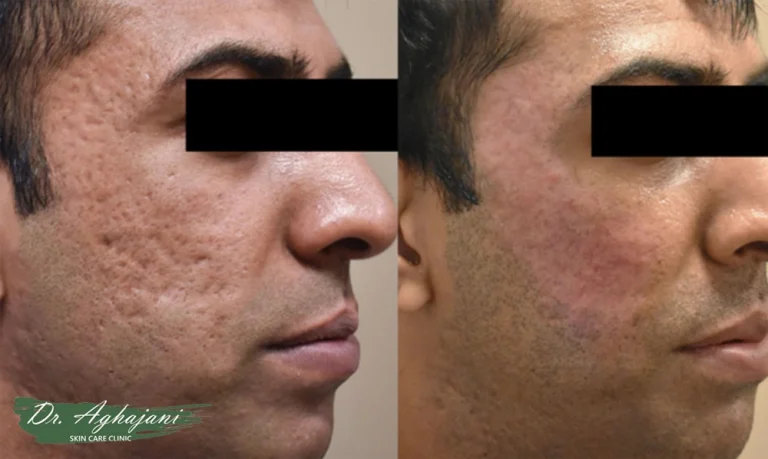 سابسیژن- سابسیژن صورت