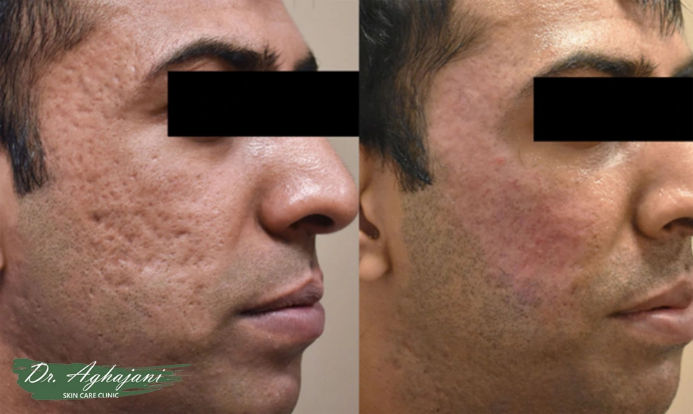 سابسیژن- سابسیژن صورت