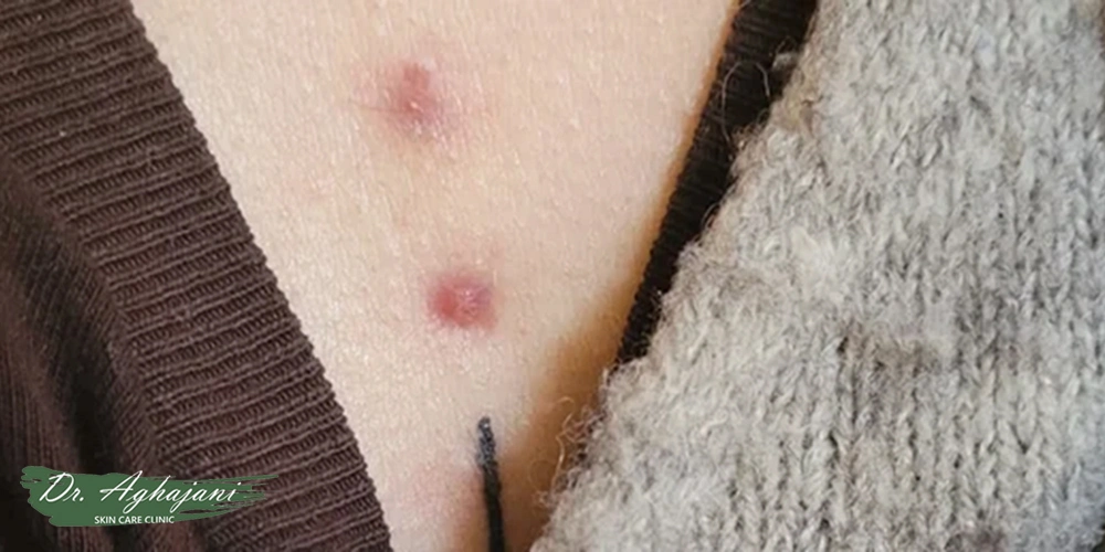 برآمدگیهای موقتی و التهابی