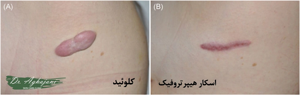 تفاوت اسکار هیپرتروفیک با کلوئید