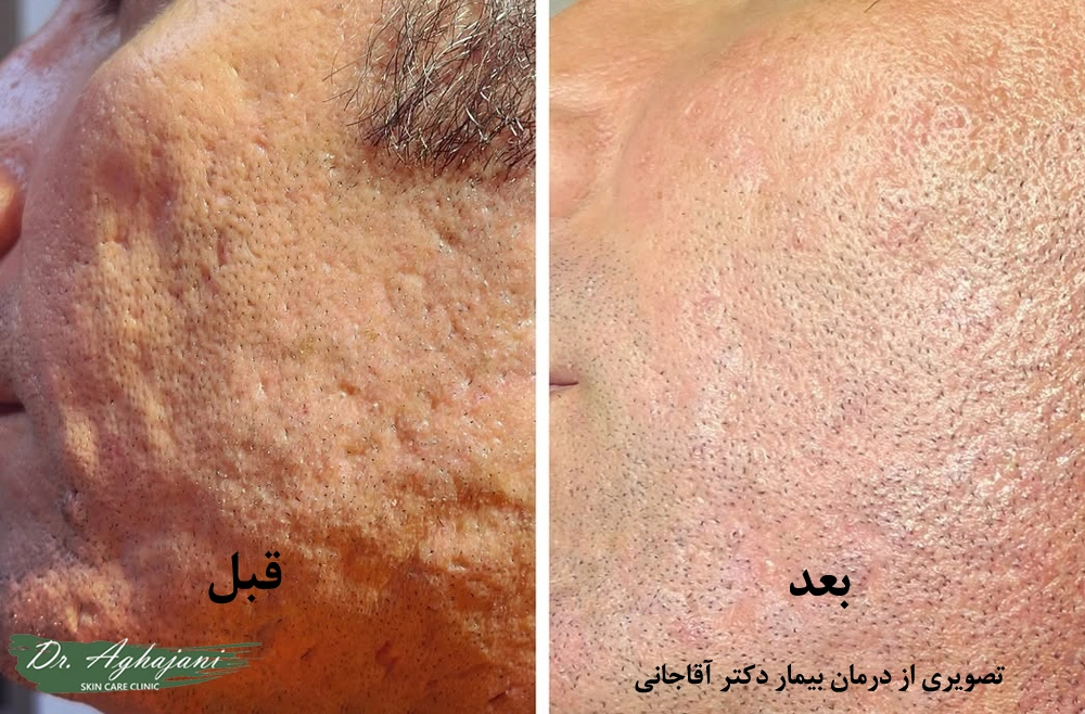 درمان جای جوش فرورفته