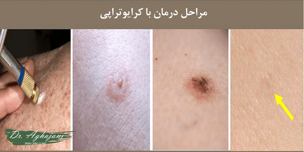 سرمادرمانی