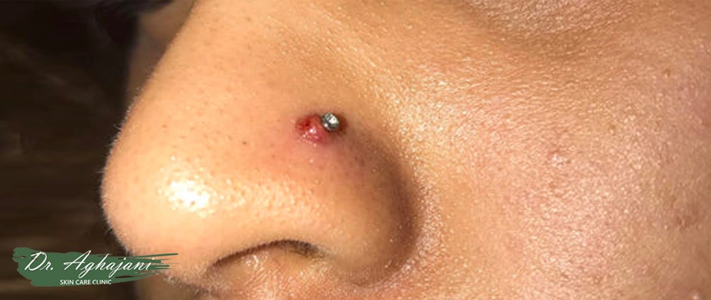 جلوگیری از مزمن شدن یا تبدیلشدن به اسکار