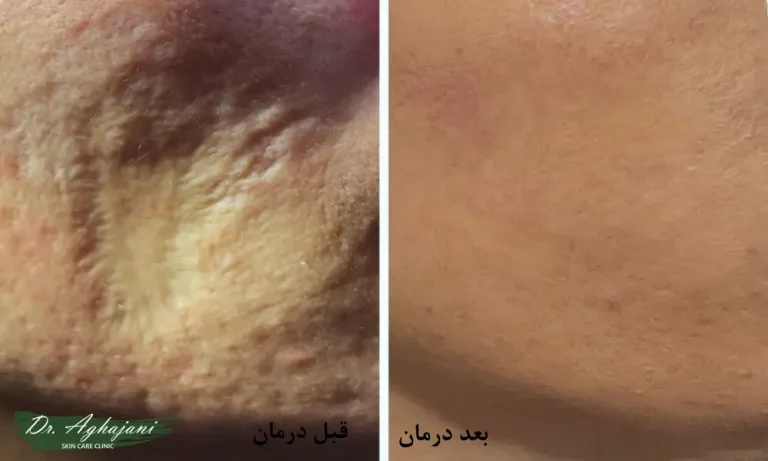 بیماری سالک