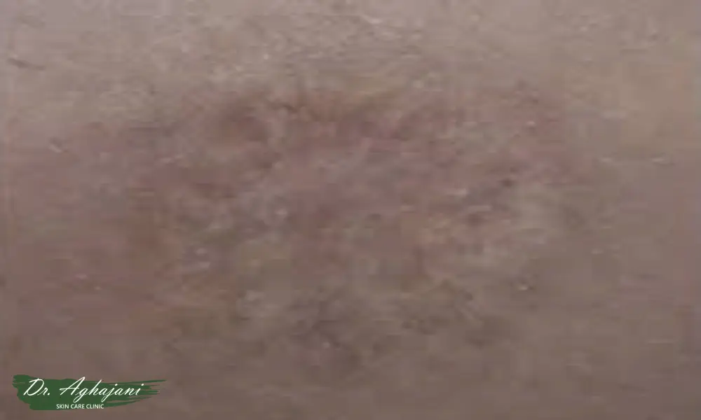 درمان اسکار و جای سالک