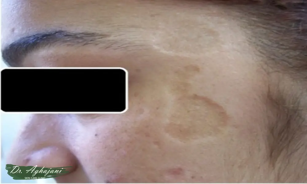 فرورفتگی ناشی از سالک