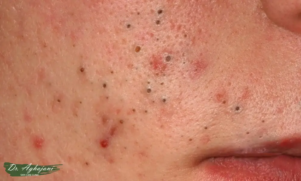 جوش‌های سرسیاه