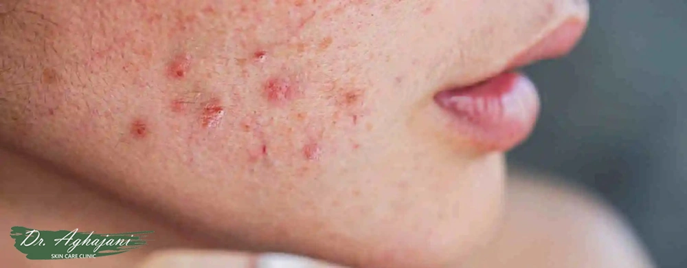 عوارض و بازگشت اسکار