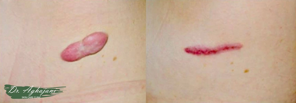 درمان با کرایوتراپی