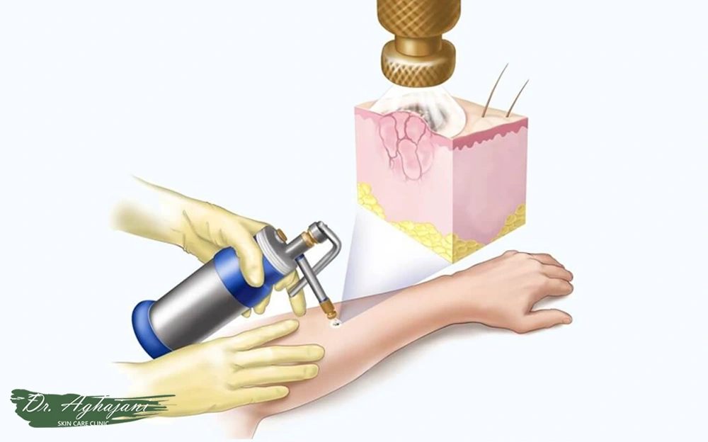 کرایوتراپی