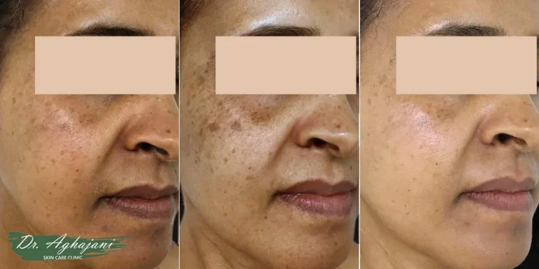 درمان قطعی لک صورت