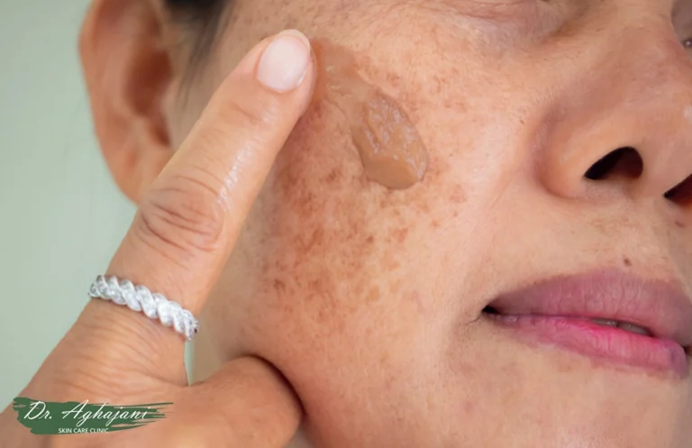 لک‌های صورت