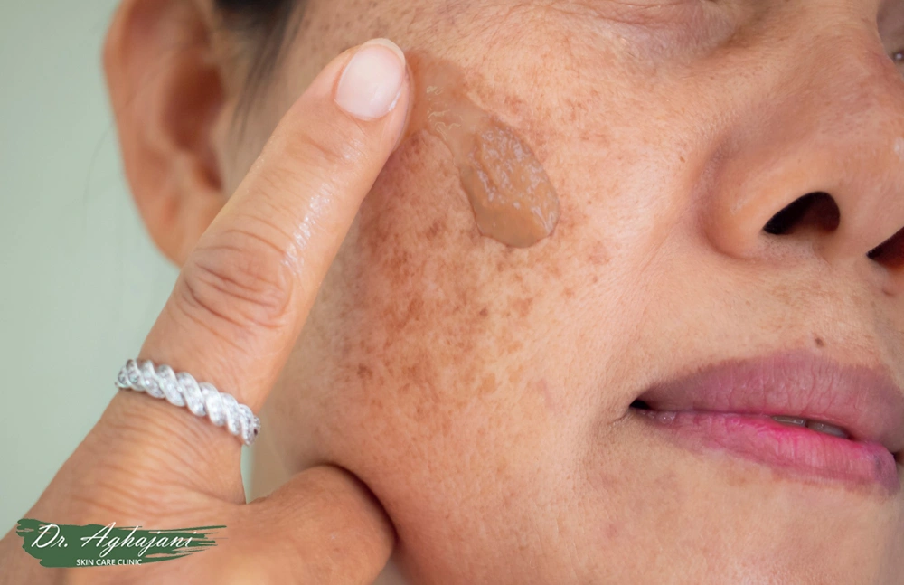 لک‌های صورت