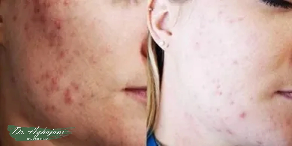 اسکارهای هیپرتروفیک